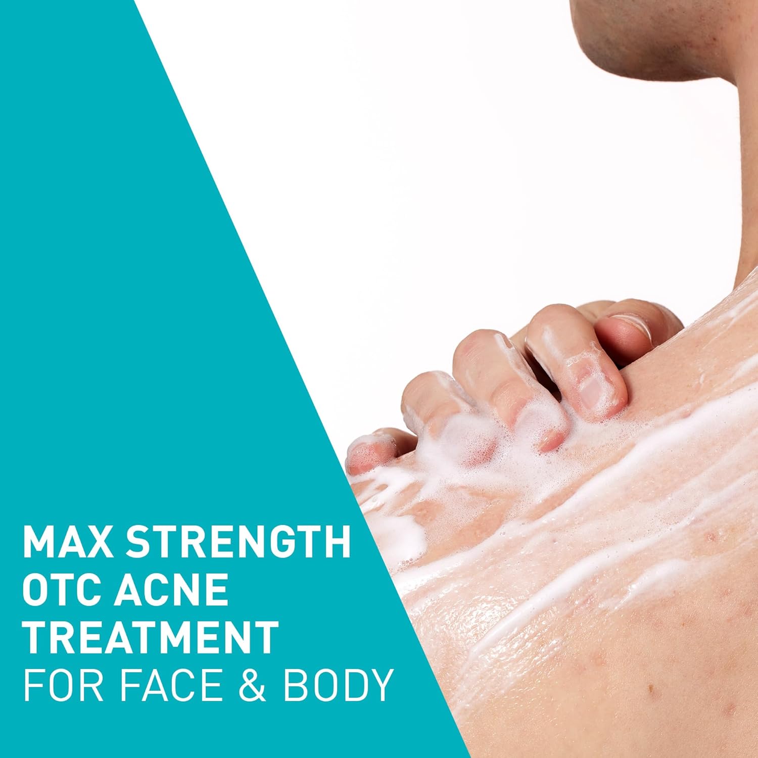 CeraVe Acne Foaming Cream Wash with 10% Benzoyl Peroxide. Treats breakouts on face & body, gentle with Niacinamide & Hyaluronic Acid. Image