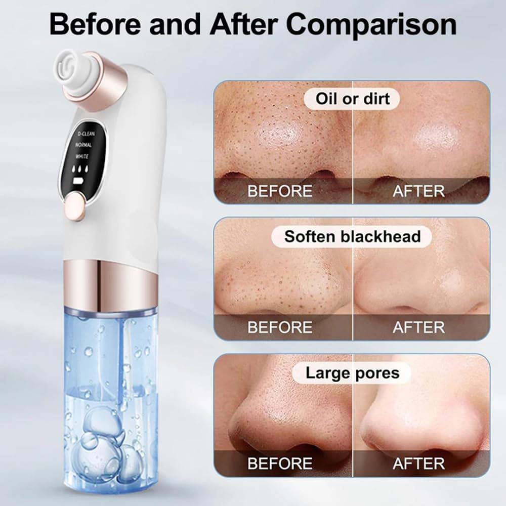 Blackhead Suction Remover Vacuum Pore Cleaner. Electric facial tool for deep cleaning blackheads & unclogging pores. Waterproof. Image