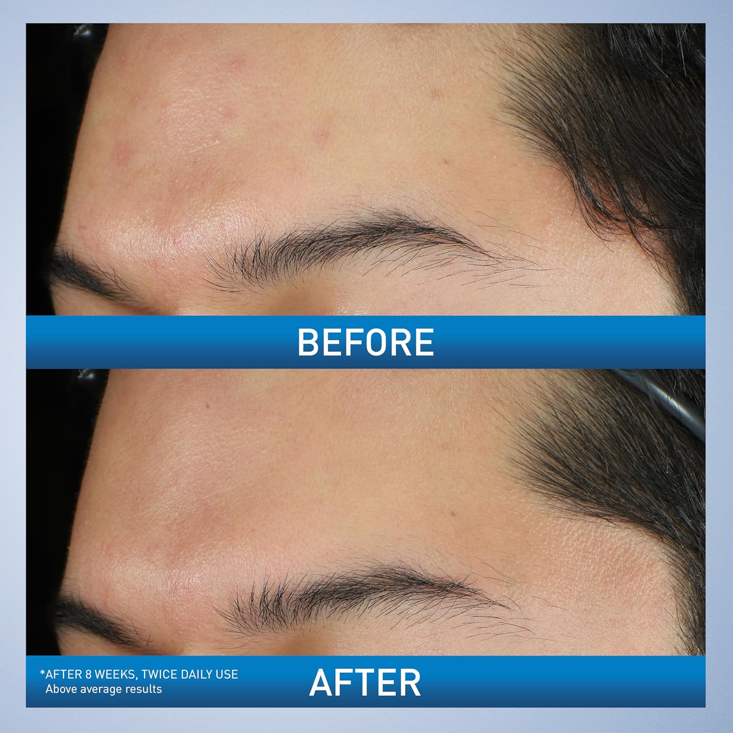 CeraVe Acne Foaming Cream Wash with 10% Benzoyl Peroxide. Treats breakouts on face & body, gentle with Niacinamide & Hyaluronic Acid. Image