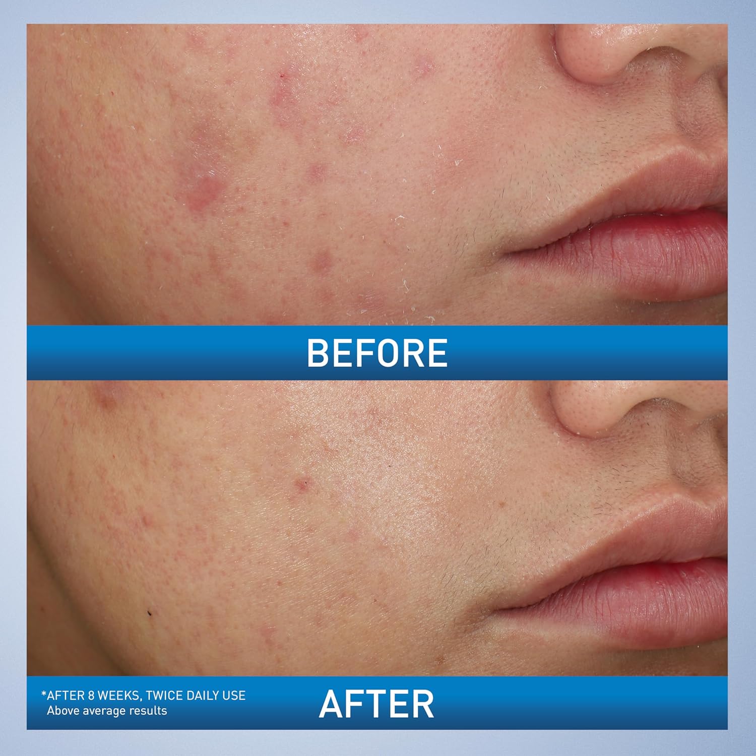 CeraVe Acne Foaming Cream Wash with 10% Benzoyl Peroxide. Treats breakouts on face & body, gentle with Niacinamide & Hyaluronic Acid. Image