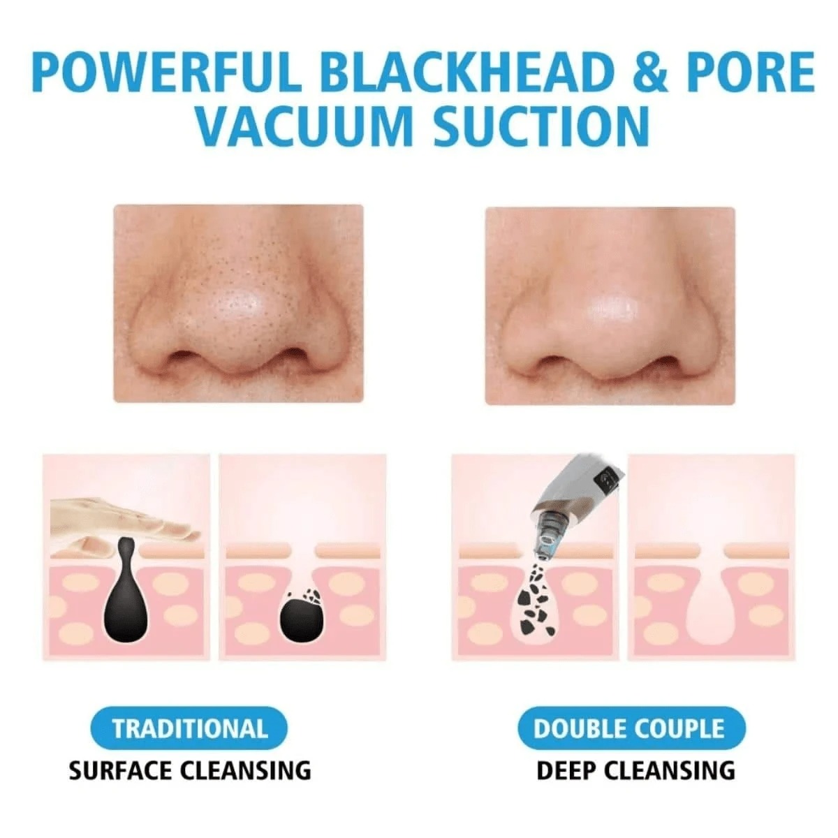 Electric Blackhead Vacuum Remover - Pore Cleanser & Pimple Sucker for Spa-Quality Facial at Home Image